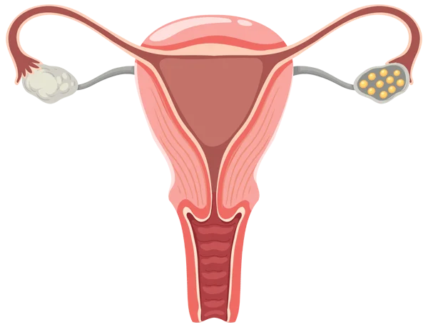 Ovarian Cyst