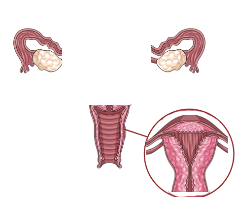 Hysterectomy Or Uterus Removal Surgery