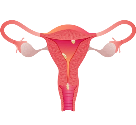 Uterine Polyps Treatment