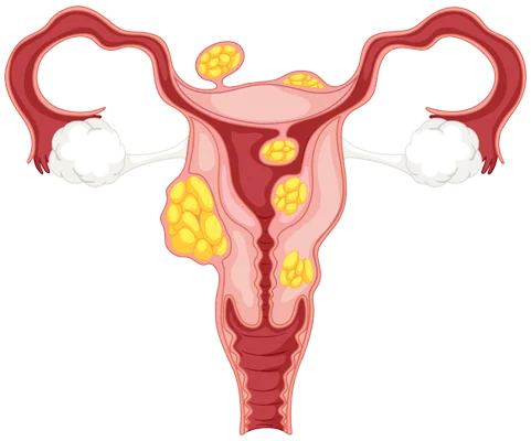 Submucous Fibroids Treatment