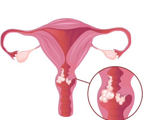 Cervical Cancer Screening